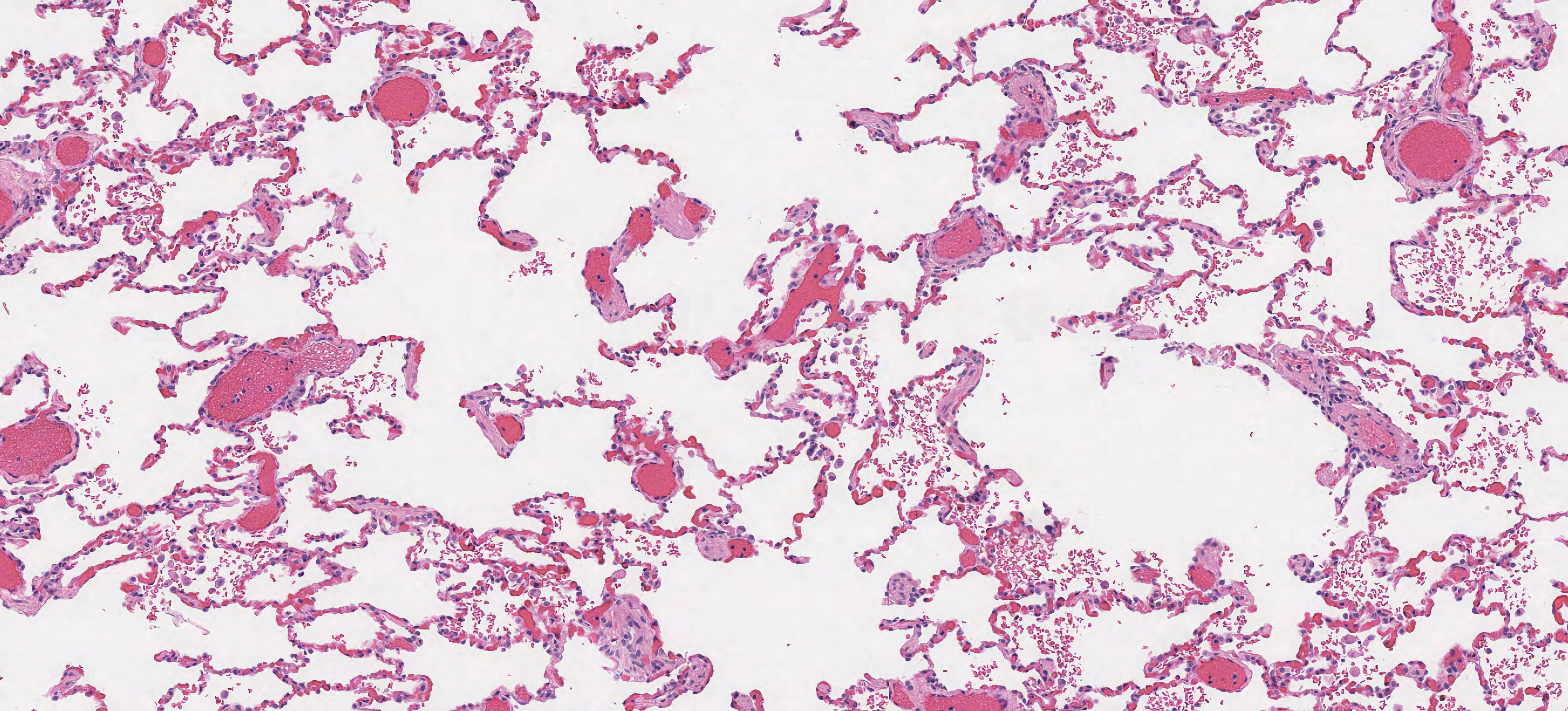 Chronic Obstructive Pulmonary Disease – Emphysema and Chronic Bronchitis