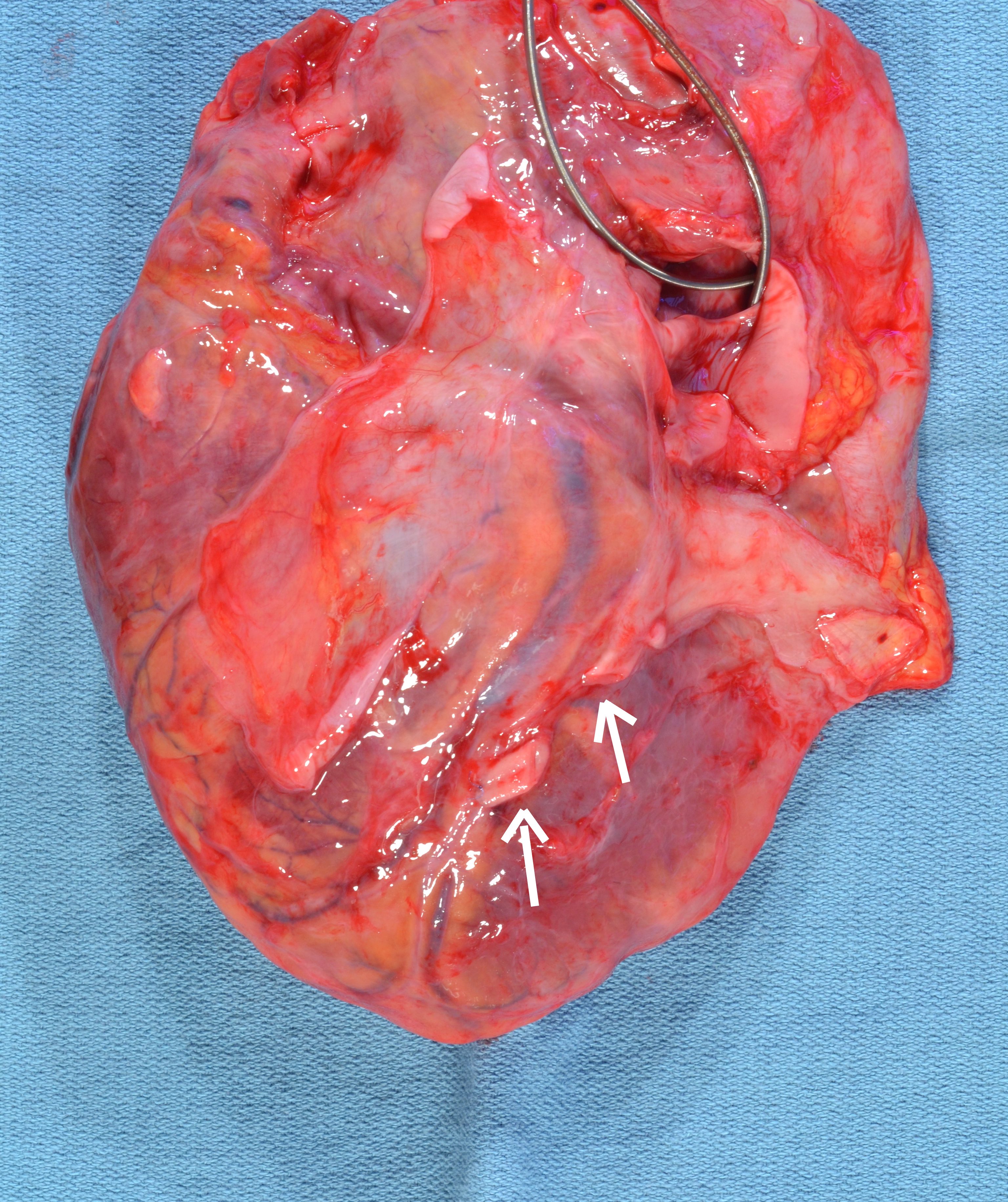 Coronary Artery Bypass Graft (CABG)