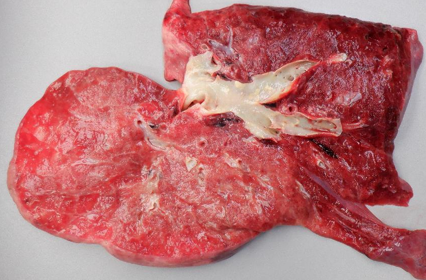 Pulmonary Hypertension