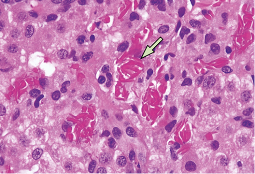 Sickle Cell Disease