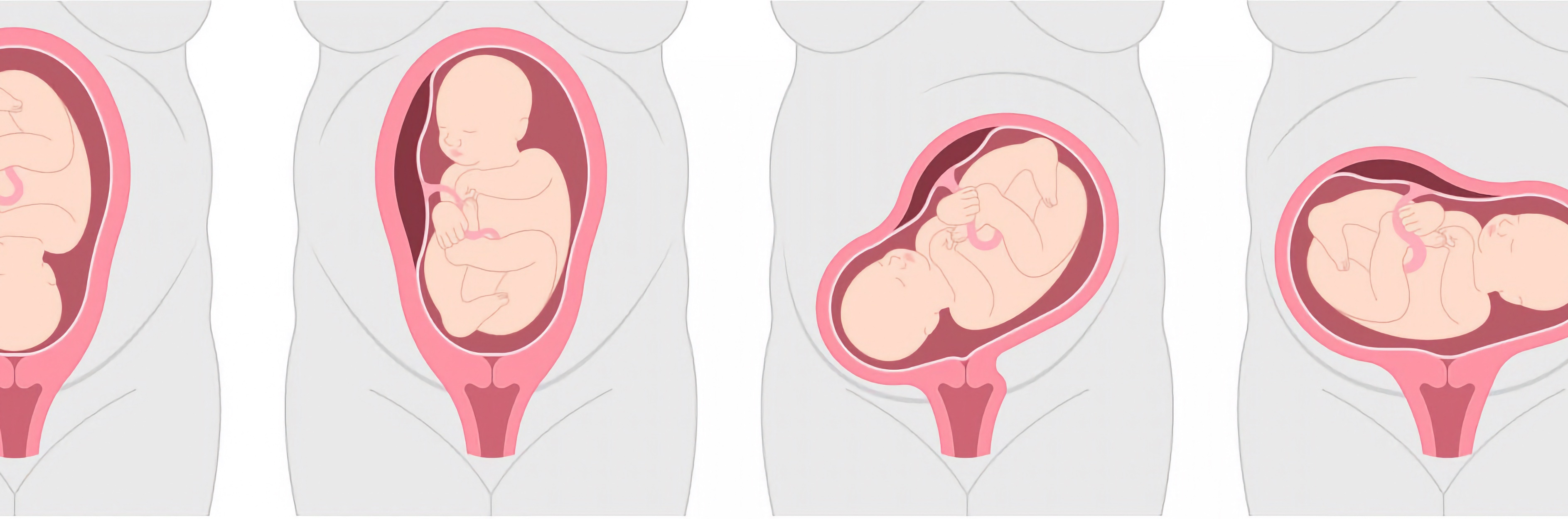 Fetal Autopsy: In Utero Lie and Presentation