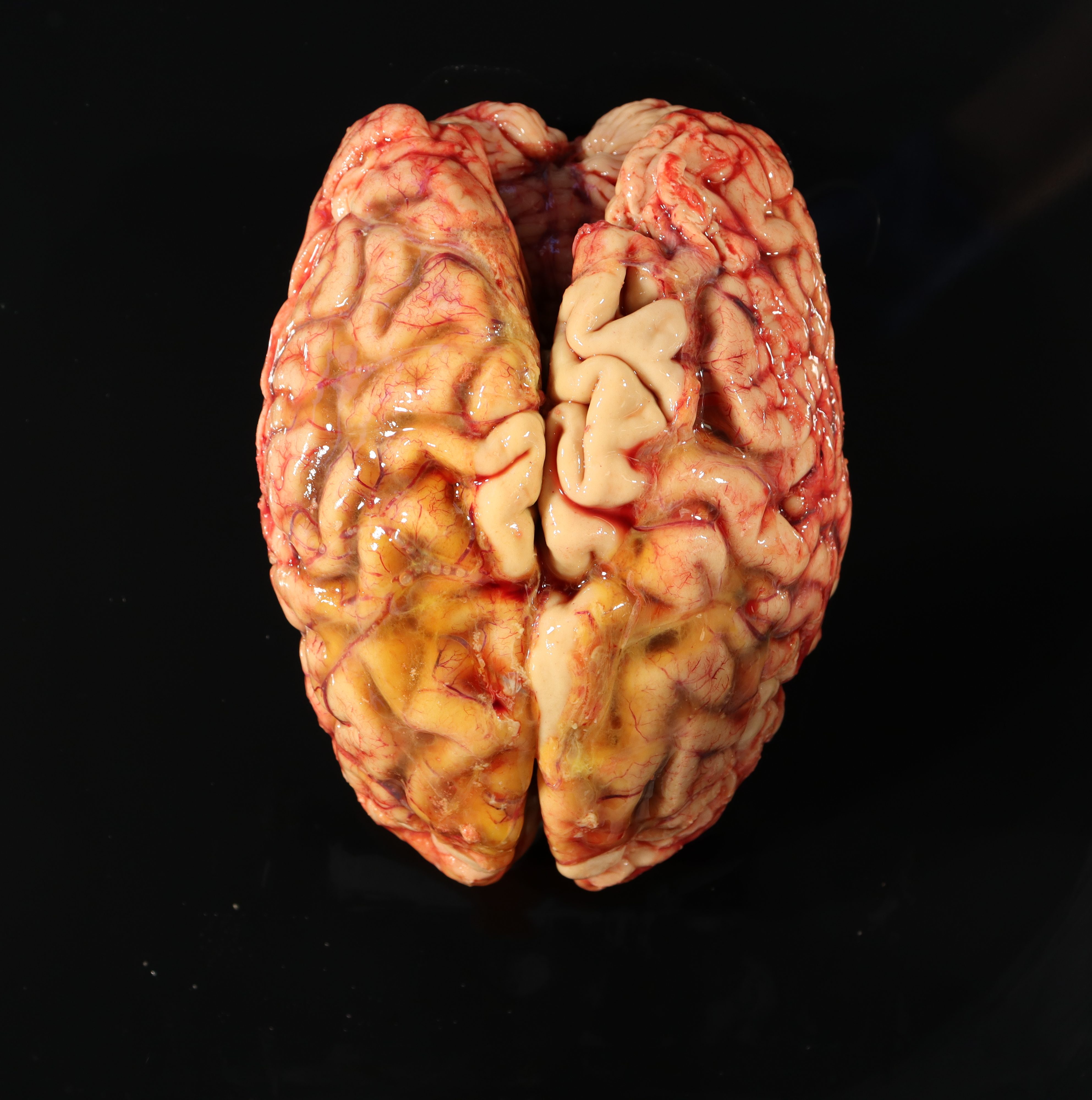 Neuropathologic Autopsy Techniques