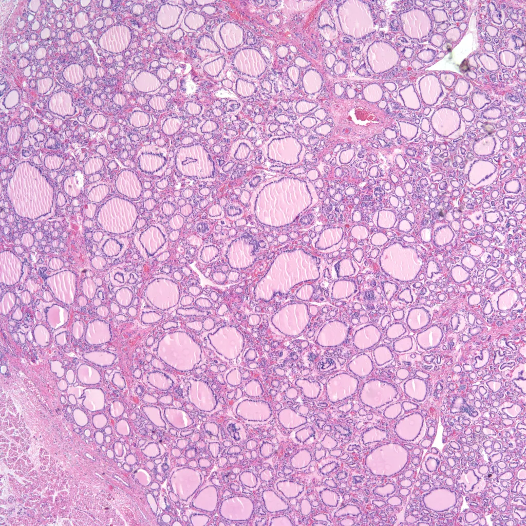 Fetal Autopsy: Thyroid