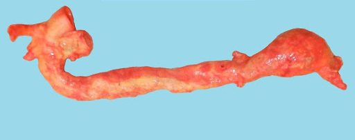 Aortic Aneurysm and Aortic Dissection