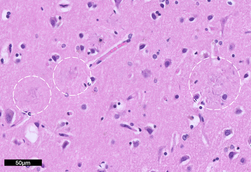 Alzheimer’s Disease