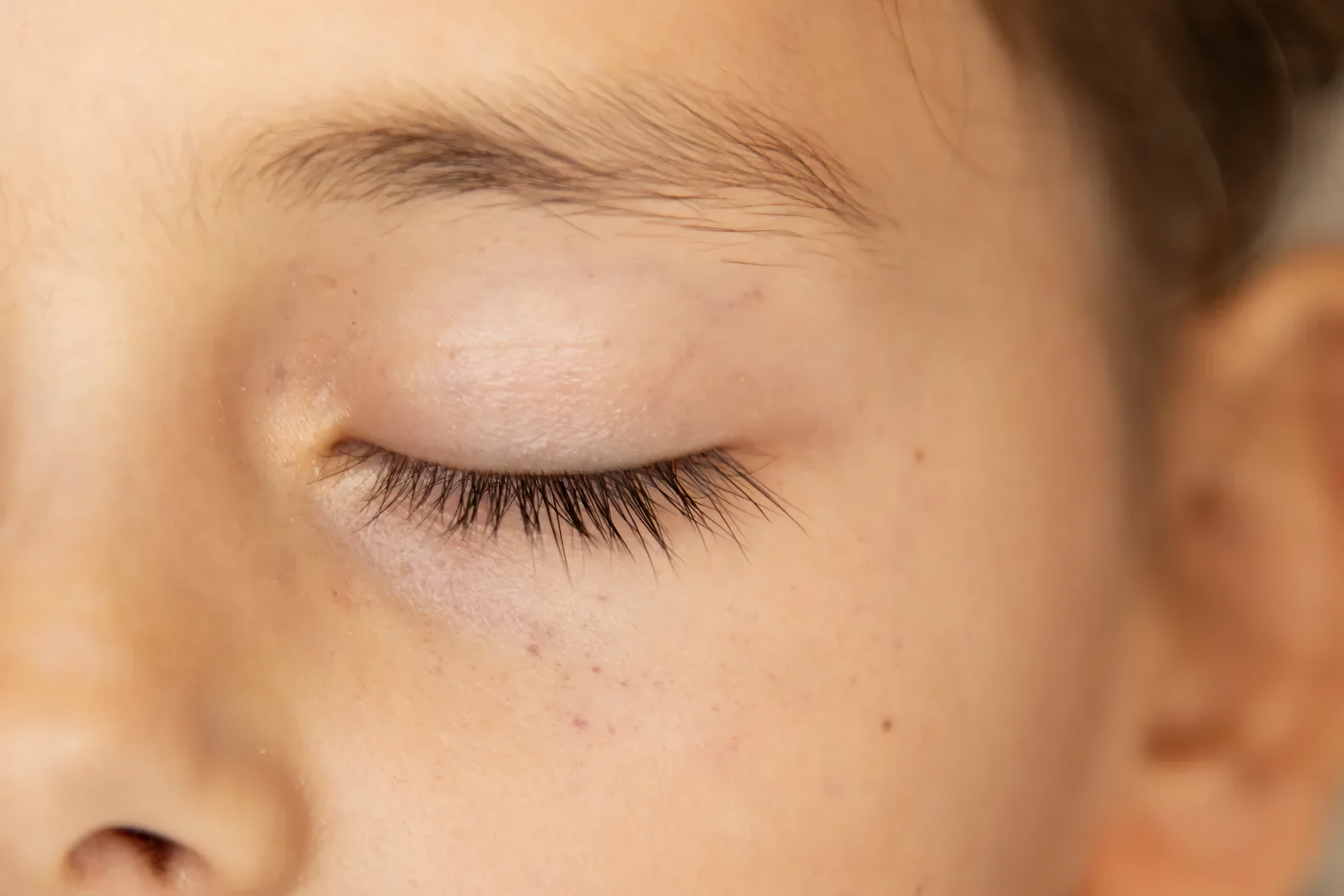 Skin Findings at Autopsy